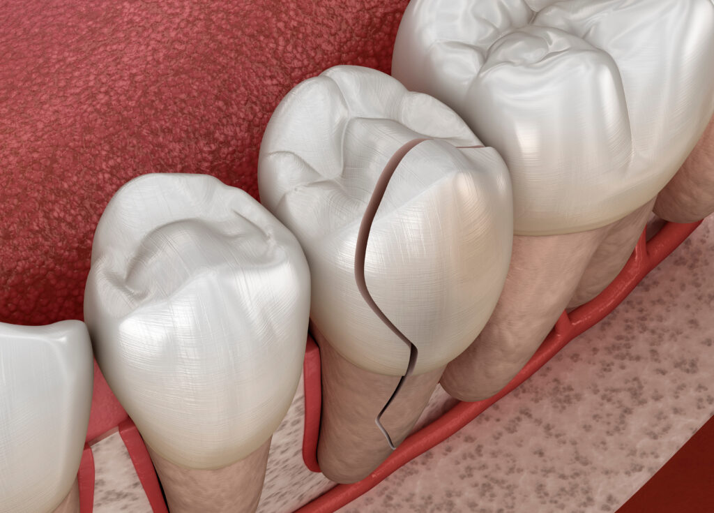 前歯が折れたら早期の治療が大事！治療は差し歯が最適？