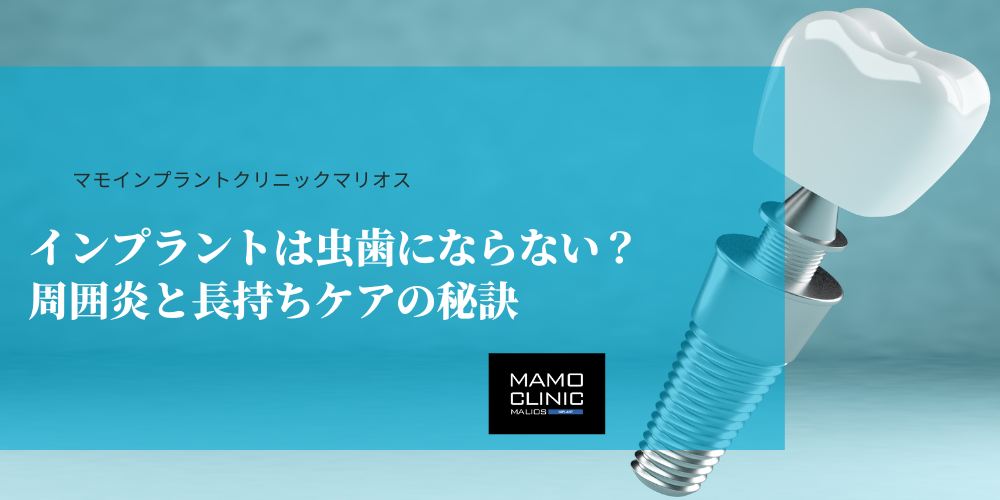 インプラントは虫歯にならない？周囲炎と長持ちケアの秘訣