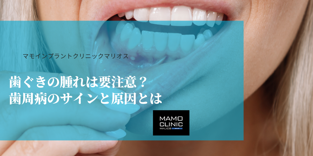 歯ぐきの腫れは要注意？歯周病のサインと原因とは