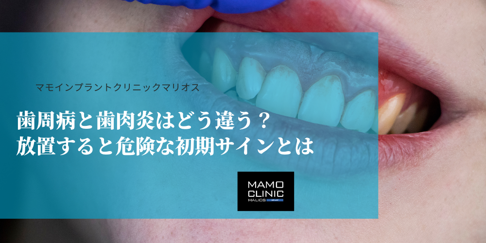 歯周病と歯肉炎はどう違う？放置すると危険な初期サインとは