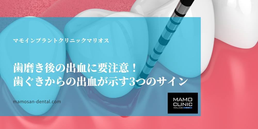 歯磨き後の出血に要注意！歯ぐきからの出血が示す3つのサイン