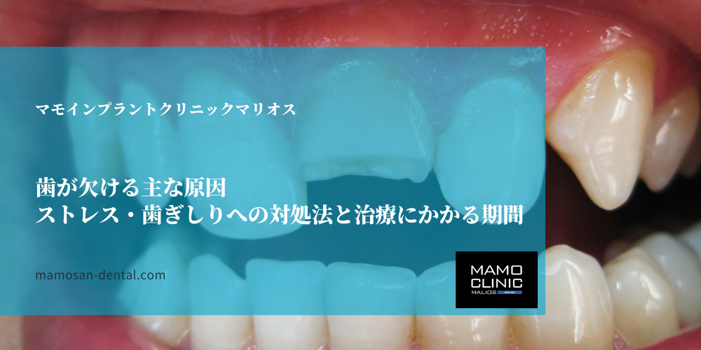 歯が欠ける主な原因｜ストレス・歯ぎしりへの対処法と治療にかかる期間