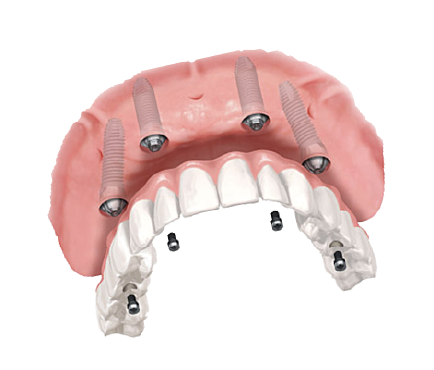 オールオン4のイメージ