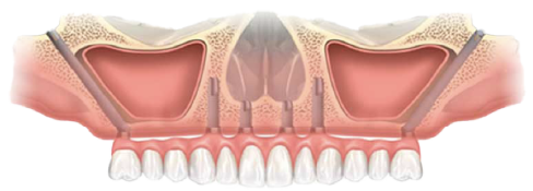 ザイゴマインプラントのイメージ