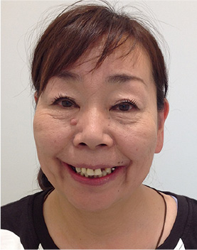 インプラント治療前の顔全体の写真（入れ歯を入れた状態）