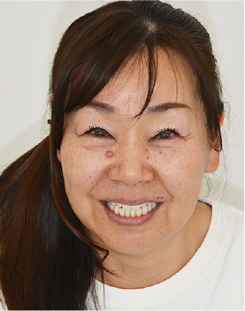 インプラント治療後の顔全体の写真