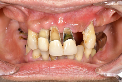 インプラント治療前の口内の写真（入れ歯を外した状態）