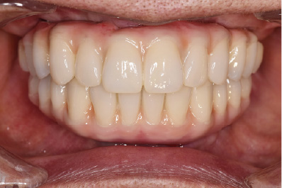 インプラント治療後の口内の写真