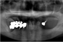治療前の口の中のレントゲン写真
