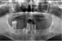 治療前の口の中のレントゲン写真