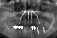 治療後の口の中のレントゲン写真
