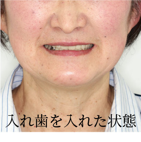 インプラント治療前の顔全体の写真（入れ歯を入れた状態）