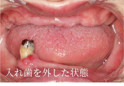 インプラント治療前の口内の写真（入れ歯を外した状態）