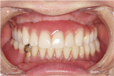 インプラント治療後の口内の写真